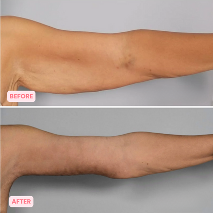 Skinnovate™ Sculpt & Tone Arm Cream