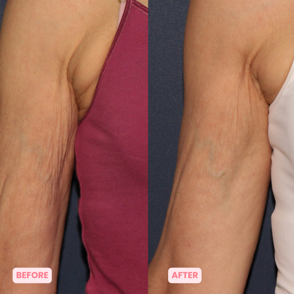 Skinnovate™ Sculpt & Tone Arm Cream